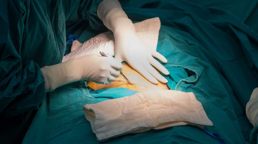 what-is-c-section-body_2_850.jpg doctor-performing-c-section